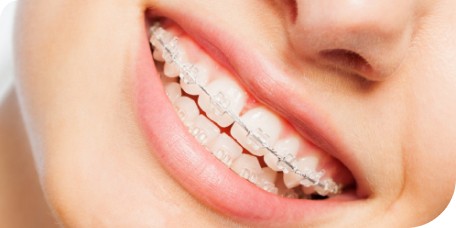 Orthodontiste Labenne conseil élastique inter-arcades