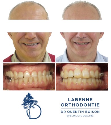 Dr Boison orthodontie cas patients Labenne
