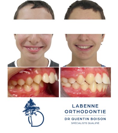 Dr Quentin Boison orthodontiste cas patients Labenne
