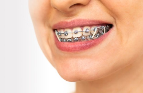 Traitement discount multibagues orthodontie