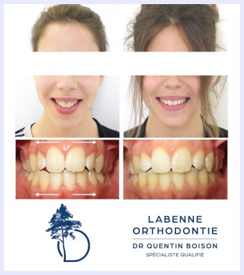 Orthodontie adulte cabinet orthodontie Labenne Dr Boison