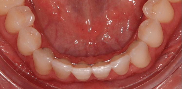 Pose de fils sur les dents antérieures