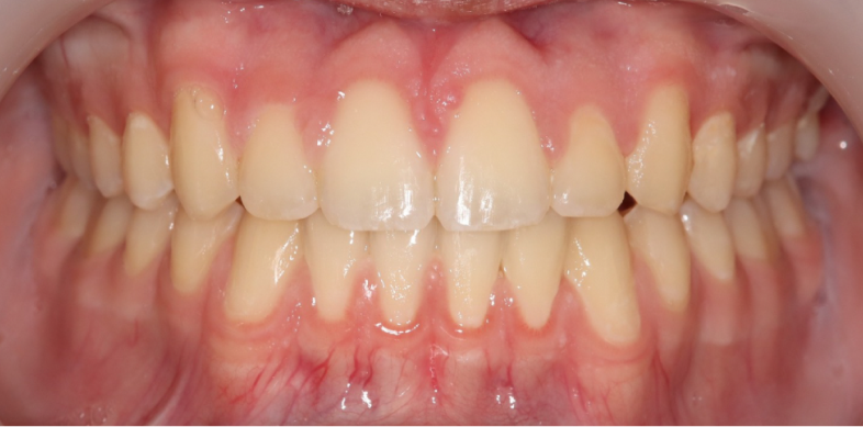 BÉANCE ET INVERSÉ D’OCCLUSION