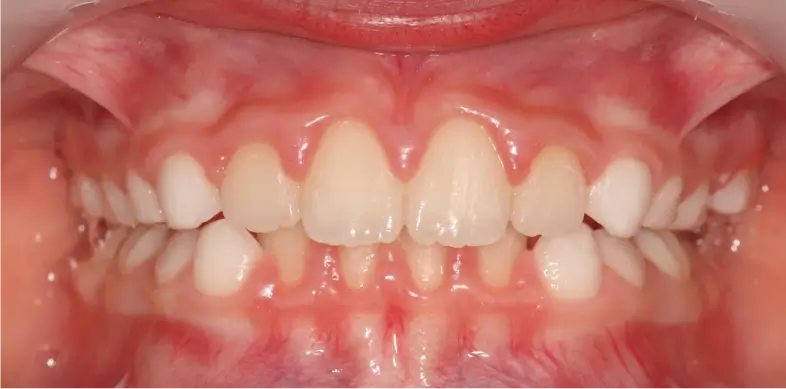 INTERCEPTIF CLASSE II.1 + INVERSÉ D’ARTICULÉ + BÉANCE