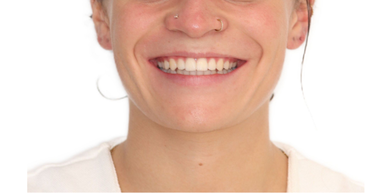 CLASSE II BIPROALVEOLIE