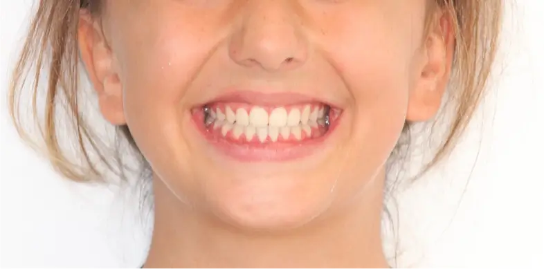 CLASSE II.2 + INVERSÉ D’ARTICULÉ + DDM