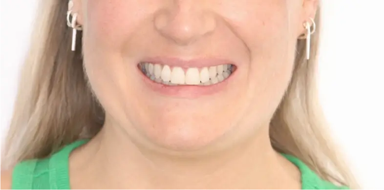 CLASSE II.2 SUPRACLUSION + CHIRURGIE AVANCÉE MANDIBULAIRE