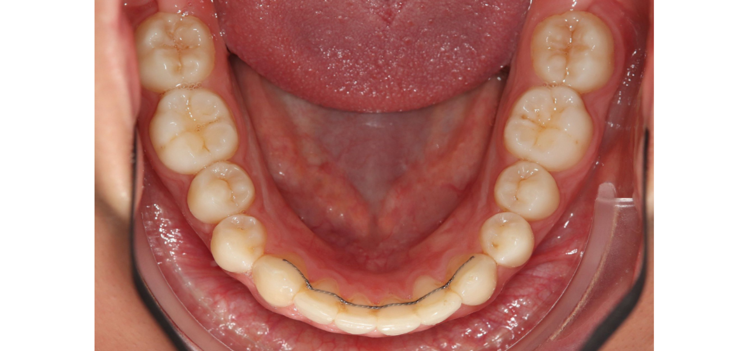 Exemples de cas traités par le Dr Quentin Boison