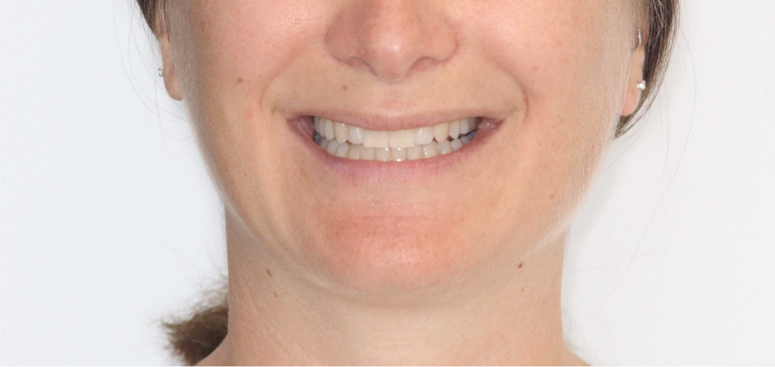 Exemples de cas traités par le Dr Quentin Boison