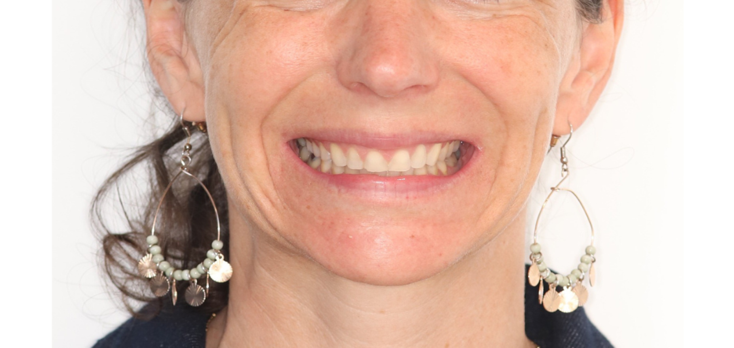 Exemples de cas traités par le Dr Quentin Boison