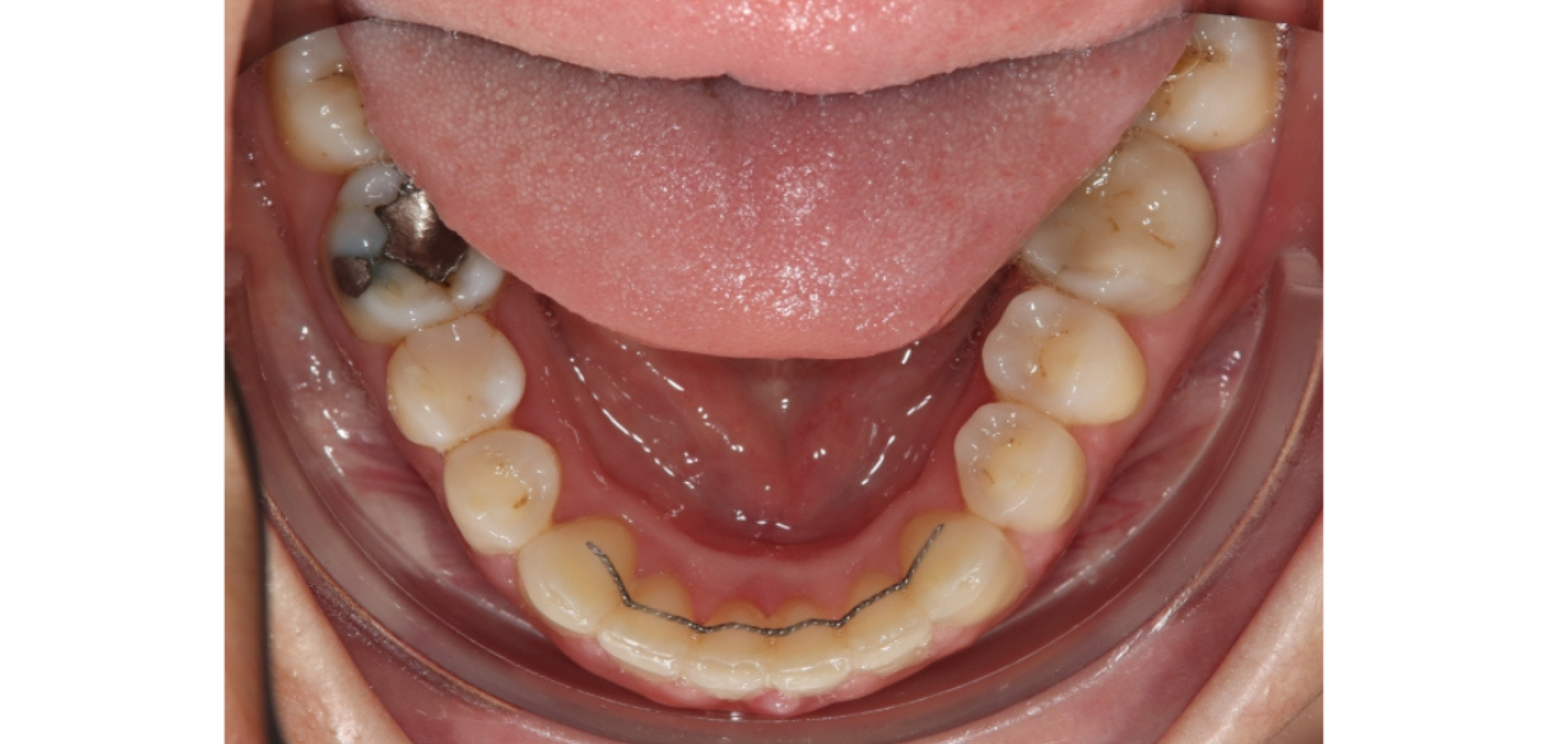 Exemples de cas traités par le Dr Quentin Boison
