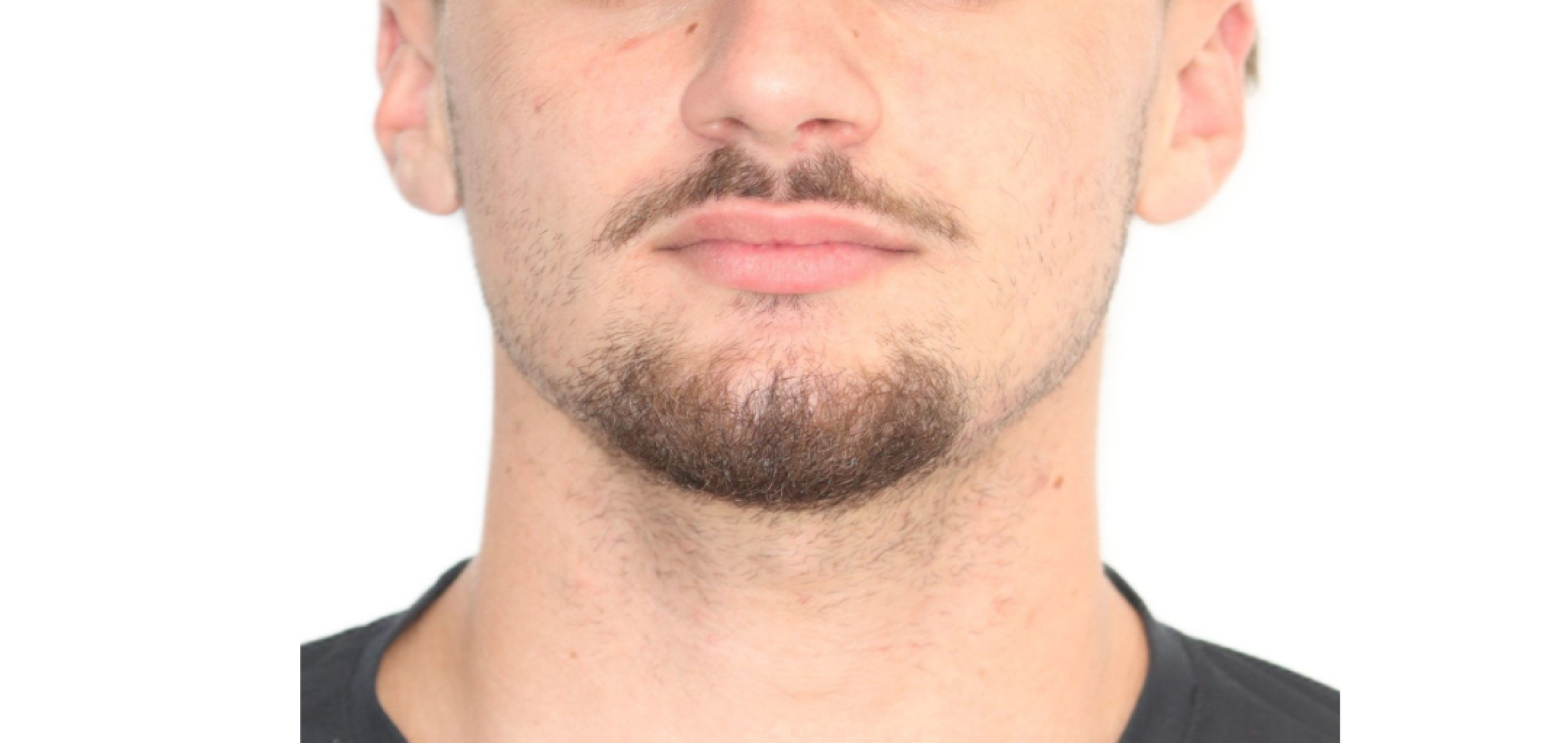 Exemples de cas traités par le Dr Quentin Boison