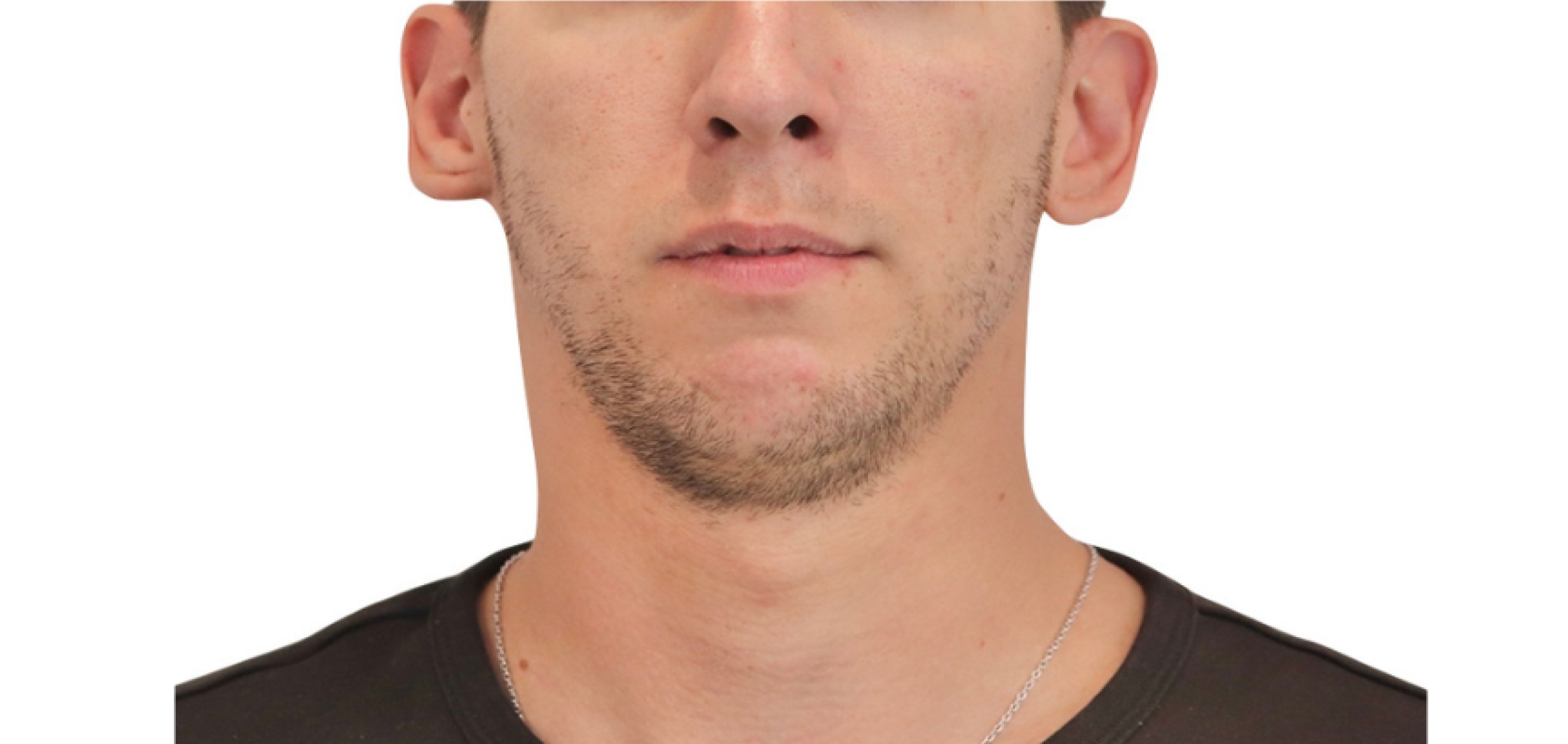 Exemples de cas traités par le Dr Quentin Boison