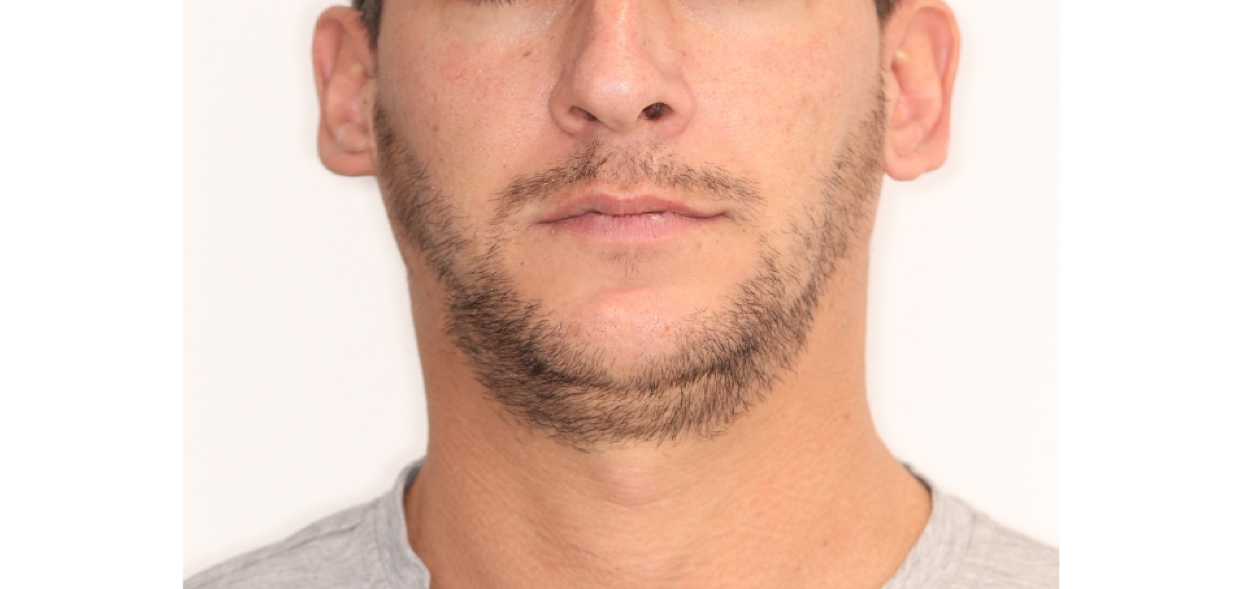 Exemples de cas traités par le Dr Quentin Boison